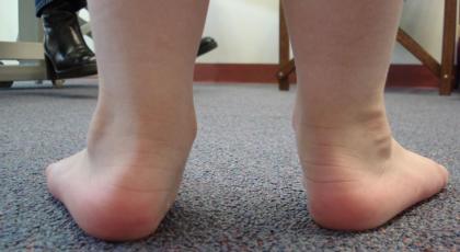 Flat feet