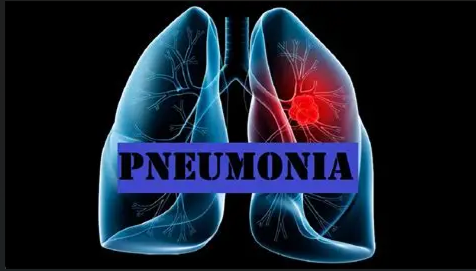 Pneumonia